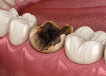 Kas sukelia „Mountain Dew“ dantų ėduonį?