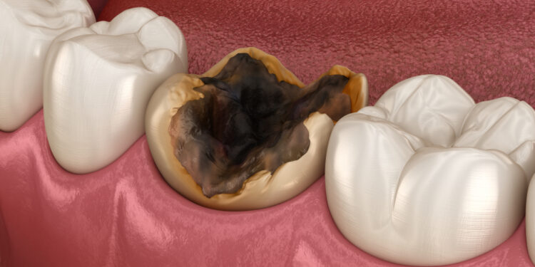 Kas sukelia „Mountain Dew“ dantų ėduonį?