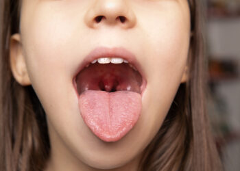 Svarbiausia apie tonzilių cistas