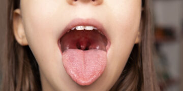 Svarbiausia apie tonzilių cistas