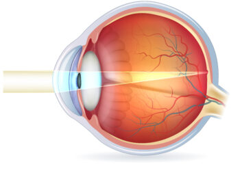Kas nutinka nustojus leisti injekcijas į akis sergant su amžiumi susijusia geltonosios dėmės degeneracija?