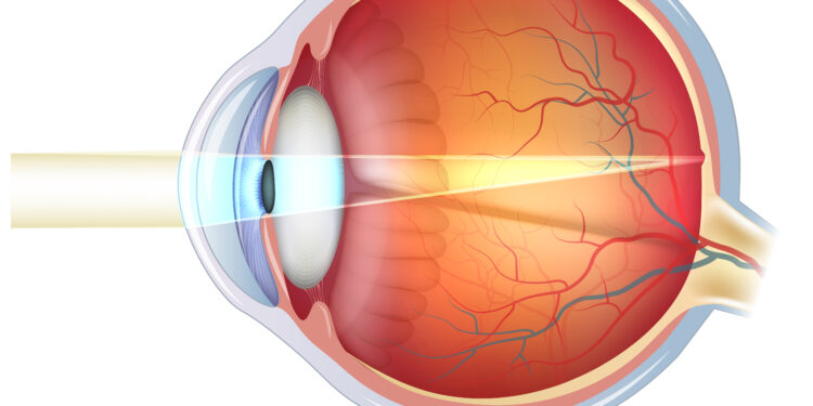 Kas nutinka nustojus leisti injekcijas į akis sergant su amžiumi susijusia geltonosios dėmės degeneracija?