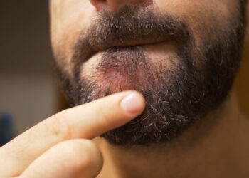 Niežtinti smakras: priežastys ir gydymas