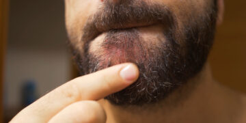 Niežtinti smakras: priežastys ir gydymas