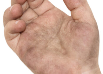 Kas yra tinea nigra?