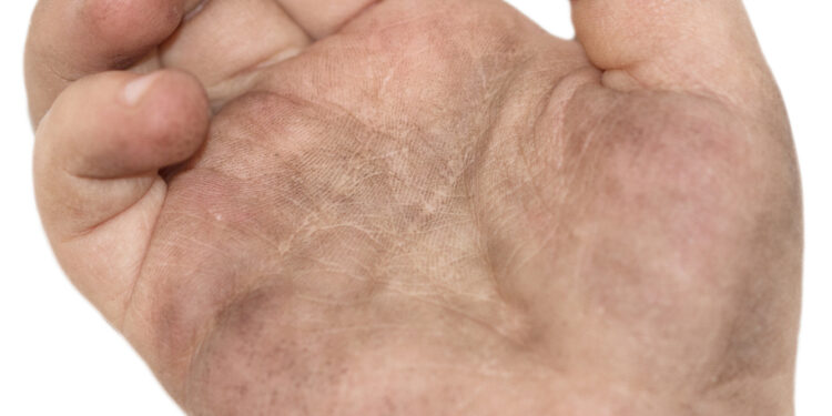 Kas yra tinea nigra?