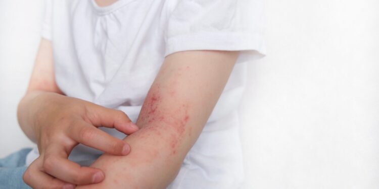 Stipriu atopiniu dermatitu sergančių žmonių krepšyje visuomet rasite šiuos 4 daiktus