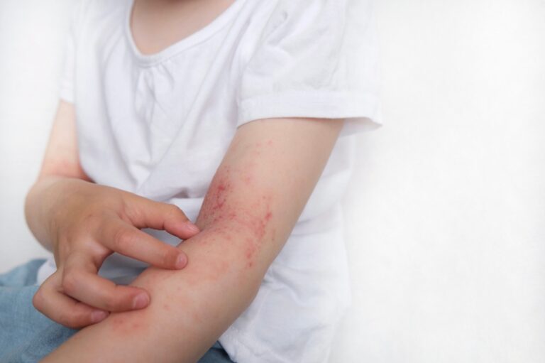 Stipriu atopiniu dermatitu sergančių žmonių krepšyje visuomet rasite šiuos 4 daiktus