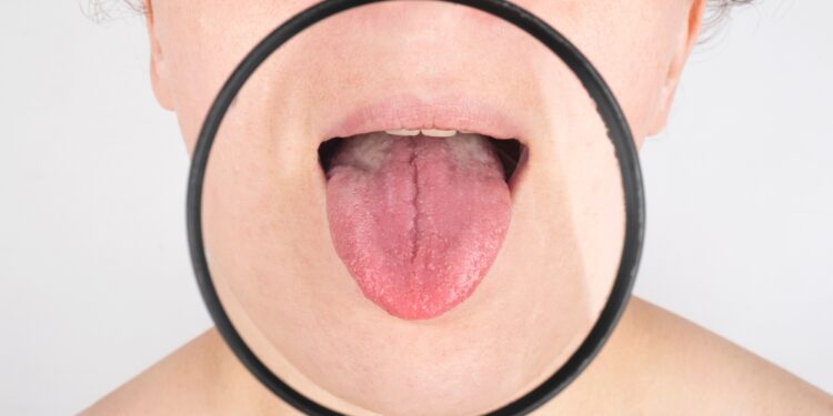 Burnos vėžys: ko tikėtis gavus diagnozę