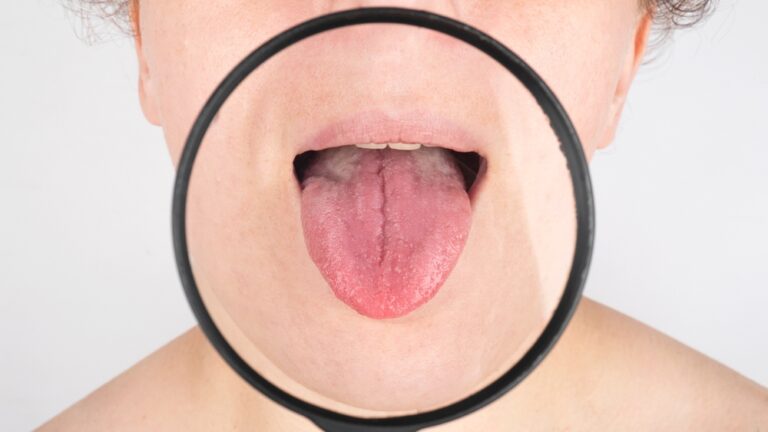 Burnos vėžys: ko tikėtis gavus diagnozę
