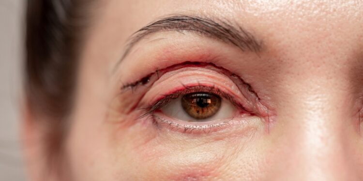 Nudegę vokai: ką svarbu žinoti