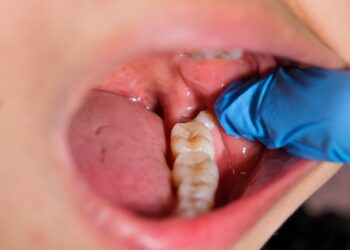 Ar būtina šalinti protinius dantis?