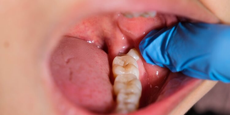 Ar būtina šalinti protinius dantis?