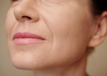 Kas sukelia įdubusius skruostus ir ar juos galima gydyti?