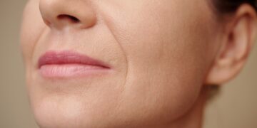 Kas sukelia įdubusius skruostus ir ar juos galima gydyti?