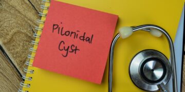 Uodegikaulio cistų gydymas namuose