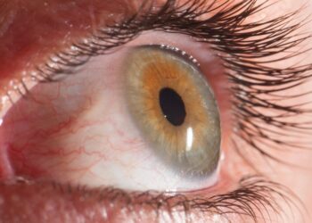 Kas sukelia įaugusią blakstieną ir kaip ją gydyti?