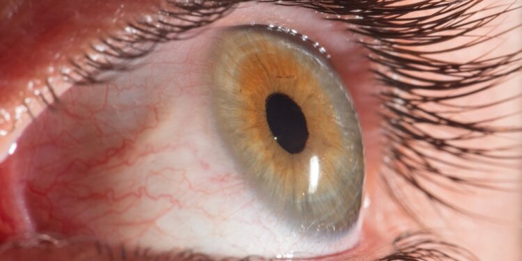 Kas sukelia įaugusią blakstieną ir kaip ją gydyti?