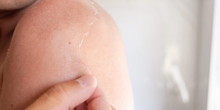 Kaip Sustabdyti Odos Šerpetojimąsi