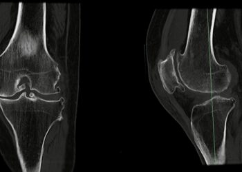 Lūžęs šlaunikaulis
