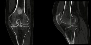 Lūžęs šlaunikaulis