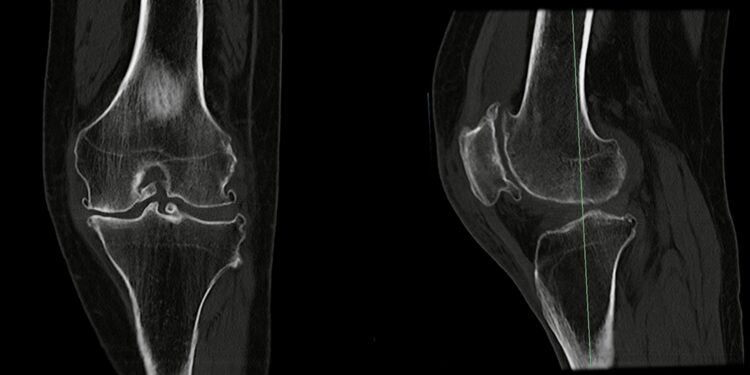 Lūžęs šlaunikaulis