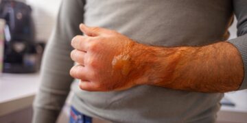 Ar reikia pradurti nudegimo pūslę?