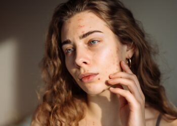 Streso ir aknės sąsaja