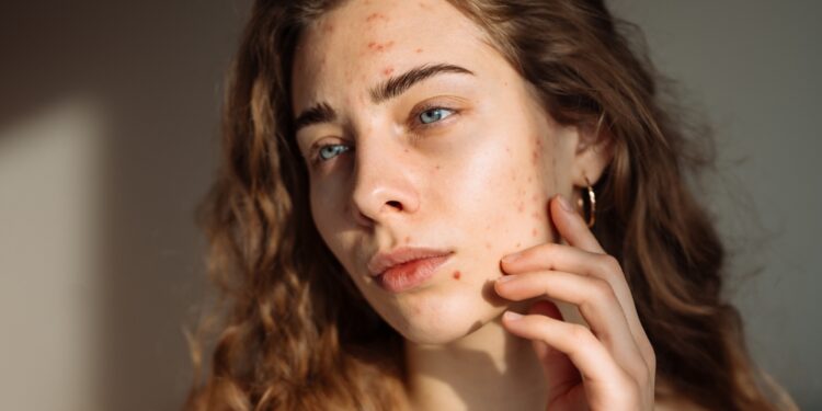 Streso ir aknės sąsaja