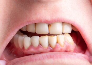 Kaip veiksmingai gydyti ir išvengti bėrimo nuo seilių