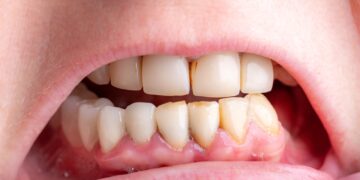 Kaip veiksmingai gydyti ir išvengti bėrimo nuo seilių