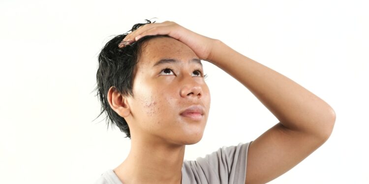 Minociklinas – veiksmingas gydymas nuo aknės?