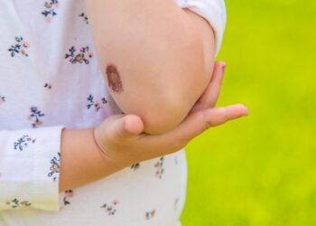 Ar verta nerimauti dėl šašo ant spenelio?