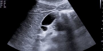 Tulžies pūslės echoskopija