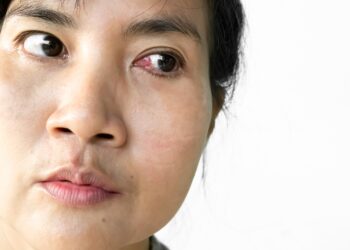 Ko tikėtis po pterigiumo operacijos