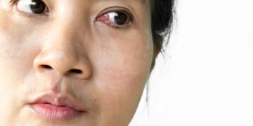 Ko tikėtis po pterigiumo operacijos