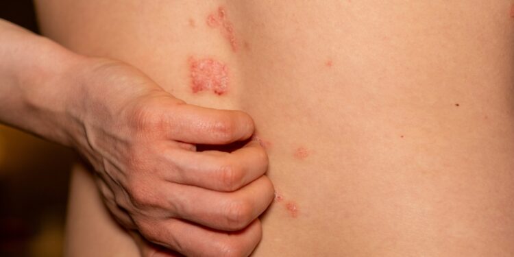 Mano herojai, kovojantys su psoriaze