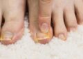 Terry nagų priežastys ir gydymo būdai