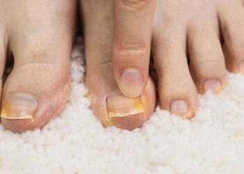 Terry nagų priežastys ir gydymo būdai
