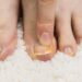 Terry nagų priežastys ir gydymo būdai