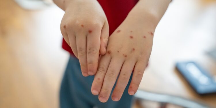 Coxsackie virusas nėštumo metu