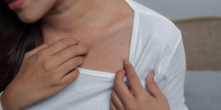 Niežtinti krūtinė