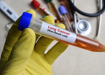 Nesmulkialąstė plaučių karcinoma: gyvenimo trukmė ir prognozė