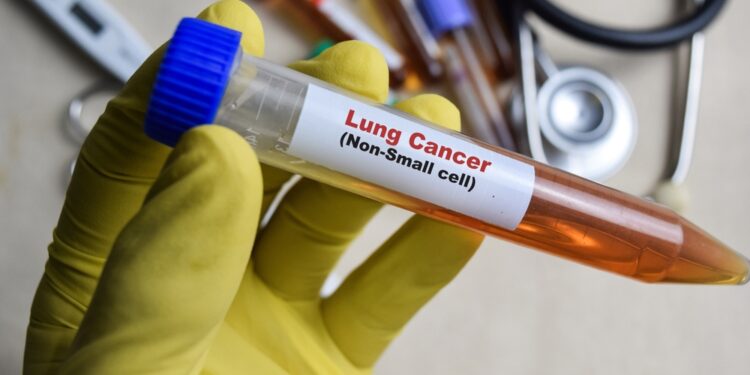 Nesmulkialąstė plaučių karcinoma: gyvenimo trukmė ir prognozė