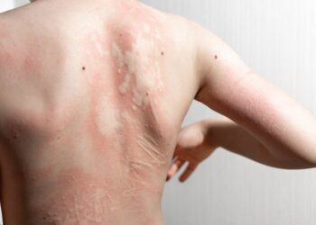 7 patarimai, kaip suvaldyti lėtinės idiopatinės dilgėlinės niežulį