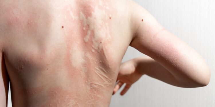 7 patarimai, kaip suvaldyti lėtinės idiopatinės dilgėlinės niežulį