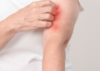 Maisto alergijos ir egzema: koks tarp jų ryšys?