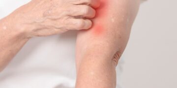 Maisto alergijos ir egzema: koks tarp jų ryšys?