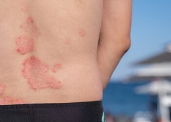 Štai kaip mažinu žvynelinės paūmėjimus vasarą