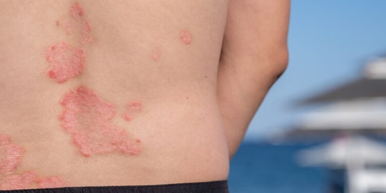 Štai kaip mažinu žvynelinės paūmėjimus vasarą